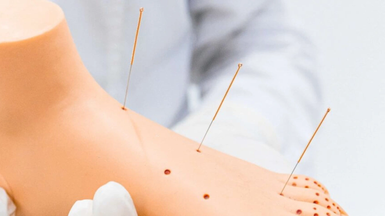 blog-acupuncture